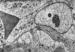 F,49y. | hemangioblastoma - brain F,49y. | hemangioblastoma - brain